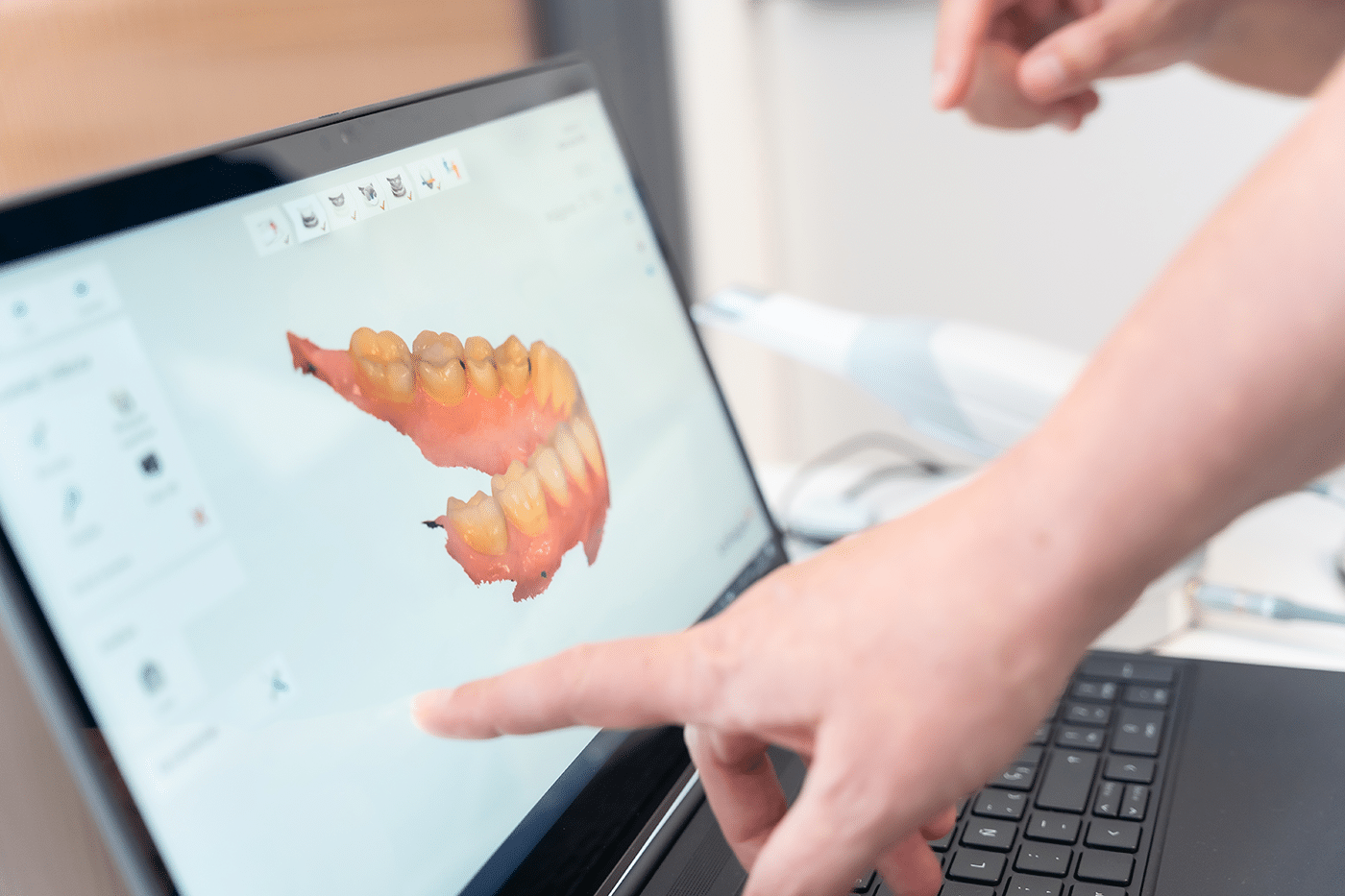 3D scan of teeth showcasing detailed structure for precise dental implant planning and placement