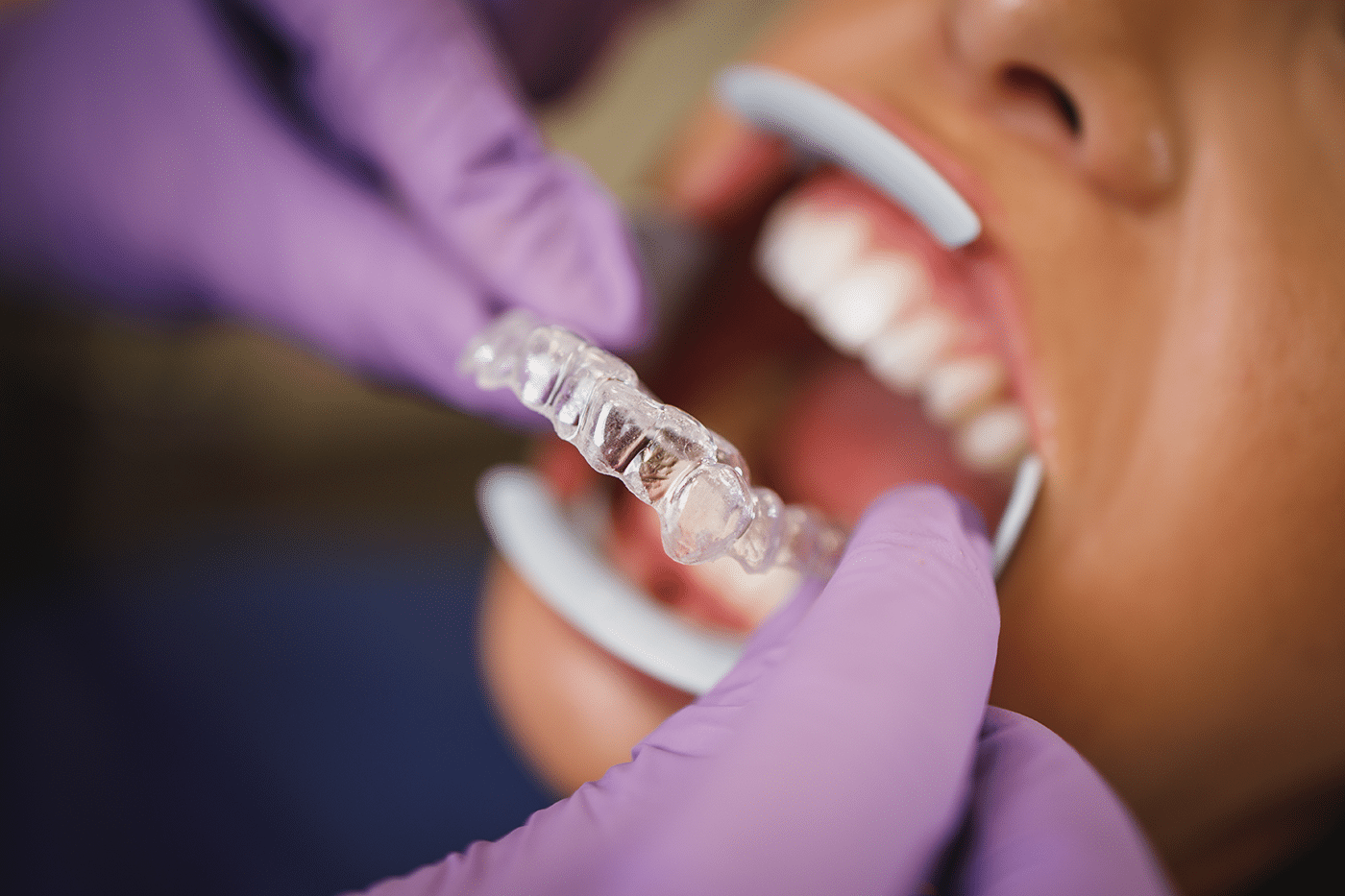 Dentist carefully fitting Invisalign aligners on a patient’s teeth in a bright, modern dental office