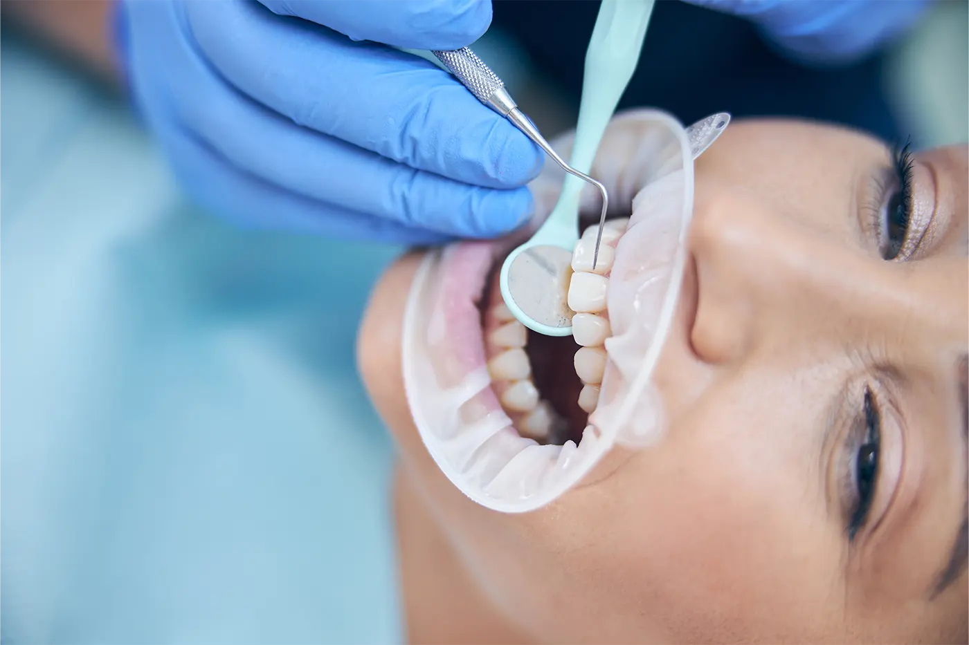 chipped tooth repair